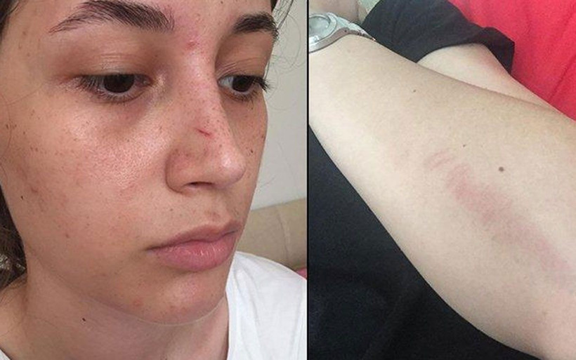 Kafaya bak! Şort giydi diye bastonla 20 yaşındaki kızın burnunu kırdı 'erkek adamım' diye savundu - Resim: 3