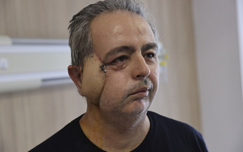 Antalya'da kanserden yüzünü kaybetti! Yapay kemik ve omzundan doku alınıp yüz yapıldı - Resim: 4