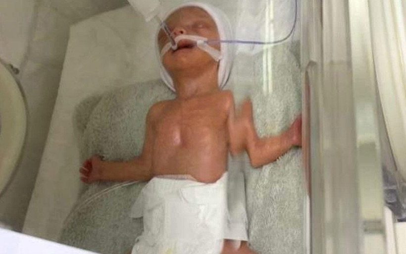 Sağlık Bakanlığı sahip çıkmıştı Alicia bebek 1 yaşına sağlıkla birlikte girdi - Resim: 1