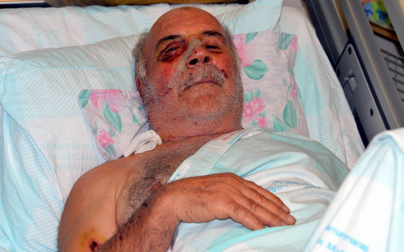 Kahramanmaraş'ta demir kesmek istedi bu hale geldi! Parçalanan yüzü vida ile onarıldı - Resim: 1