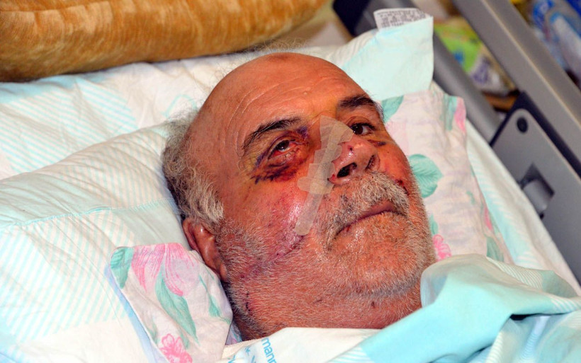 Kahramanmaraş'ta demir kesmek istedi bu hale geldi! Parçalanan yüzü vida ile onarıldı - Resim: 2