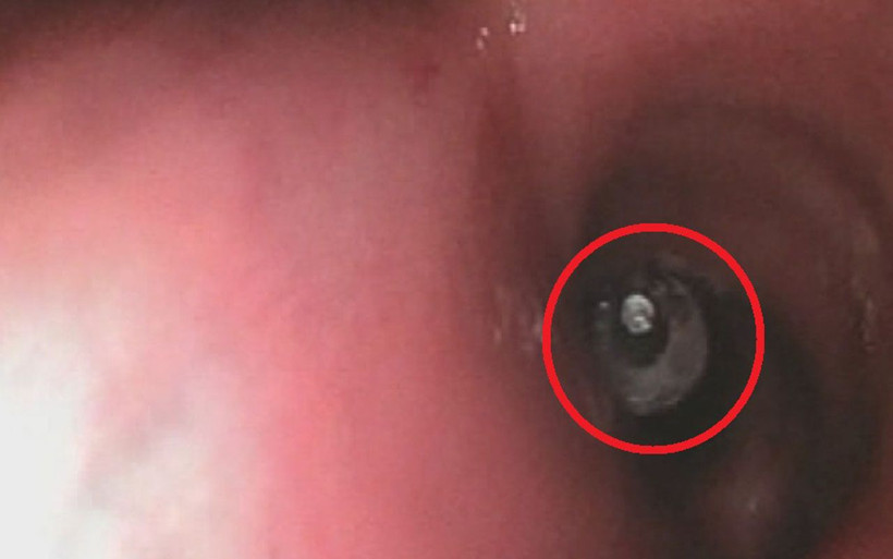 Bursa'da akciğerine kaçtı! Dişçiye implant taktırmak için gitti ucuz kurtuldu - Resim: 4