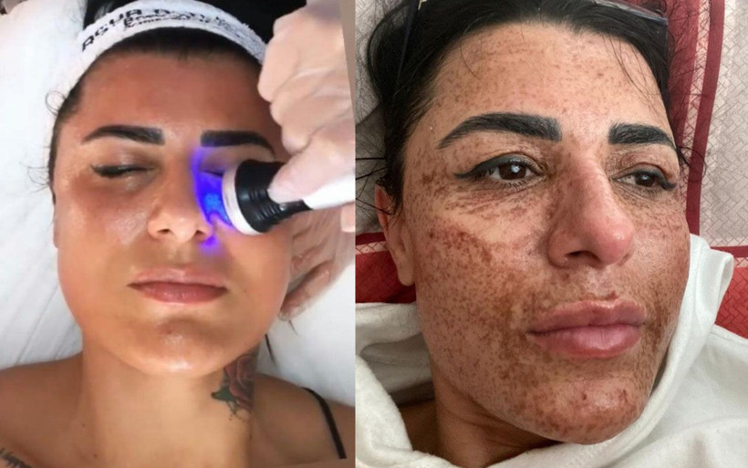 Antalya'da estetik uğruna yüzü yanan kadını bilmeyen kalmadı! Aynalarla barıştı - Resim: 2