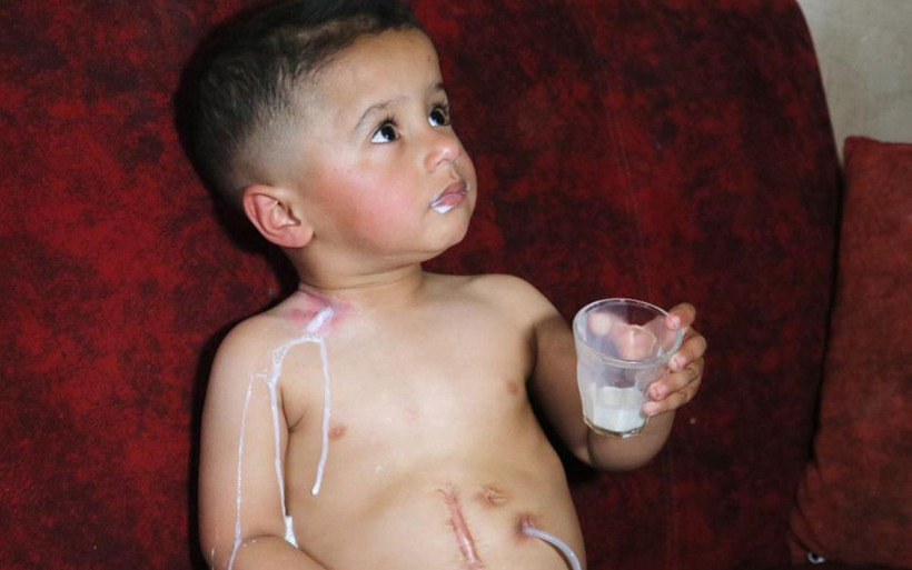 Adana'da yemek borusu olmayan Muhammed'in içtiği sıvılar boynundan fışkırıyor - Resim: 4