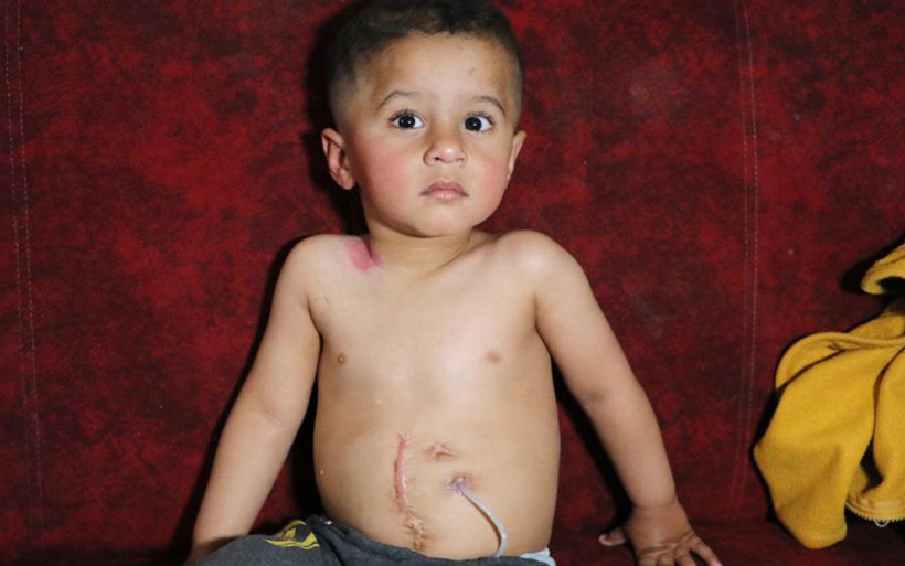 Adana'da yemek borusu olmayan Muhammed'in içtiği sıvılar boynundan fışkırıyor - Resim: 2