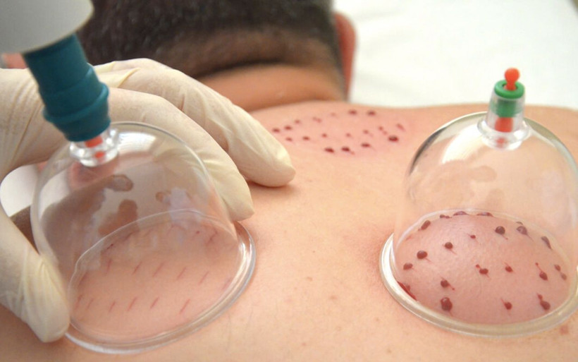 Hacamat yapmak orucu bozar mı? Diyanet bu konuda ne diyor? - Resim: 4