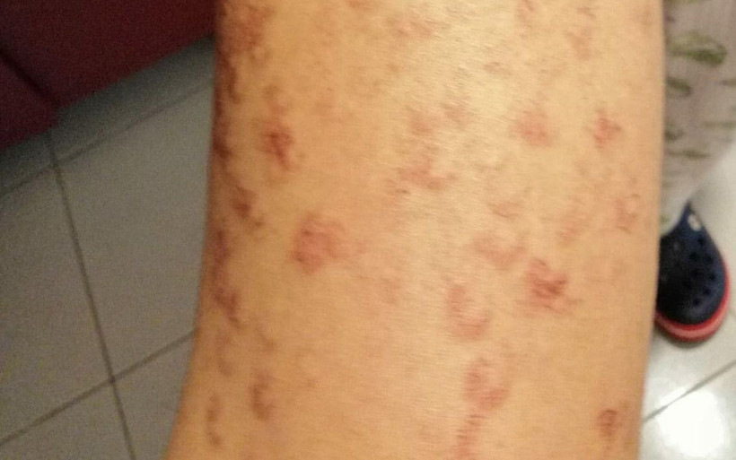 İzmir'de lazer epilasyonda bacaklarını yaktılar güzellik merkezini korku sardı! - Resim: 4