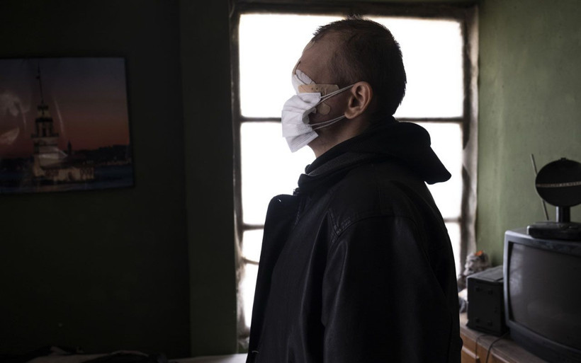 Bir siğille başladı yüzünü kaybetti! Konyalı baba çay içmeye ve kızını öpmeye hasret kaldı - Resim: 3