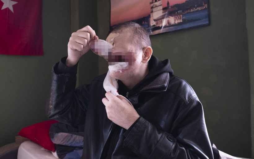 Bir siğille başladı yüzünü kaybetti! Konyalı baba çay içmeye ve kızını öpmeye hasret kaldı - Resim: 4