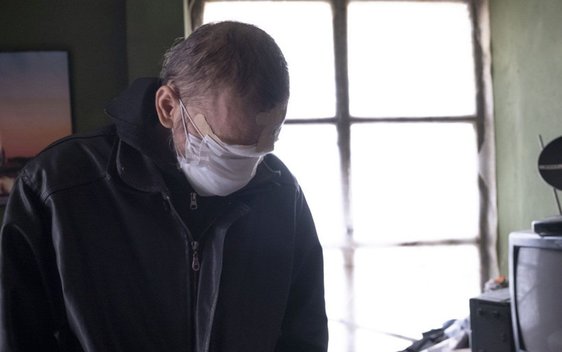 Bir siğille başladı yüzünü kaybetti! Konyalı baba çay içmeye ve kızını öpmeye hasret kaldı - Resim: 2