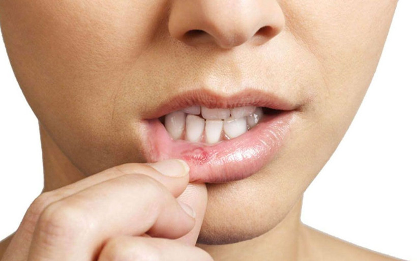 Ağızdaki aft nasıl geçer doğal yöntemler neler? - Resim: 4