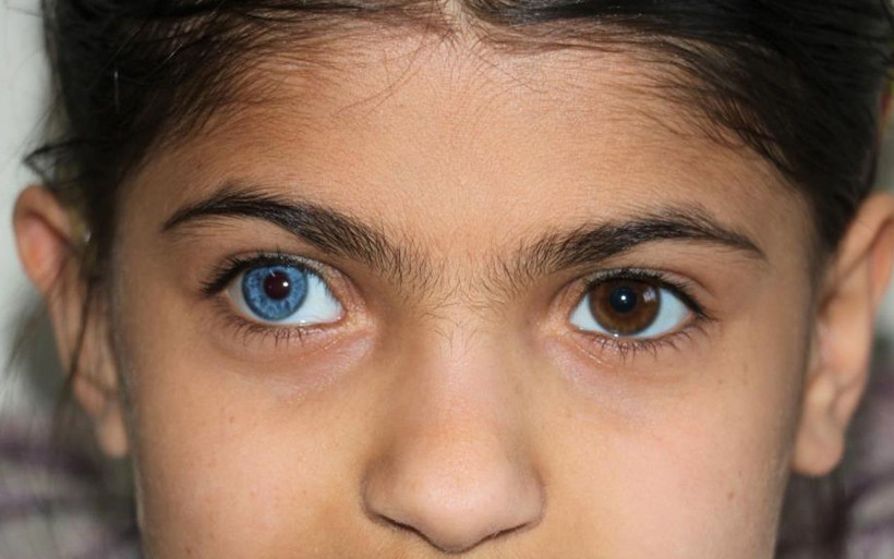 Kahramanmaraş'ta Yasin ve Elif kardeşlerin gözleri ilginç: Hayata çift renk bakıyorlar - Resim: 4