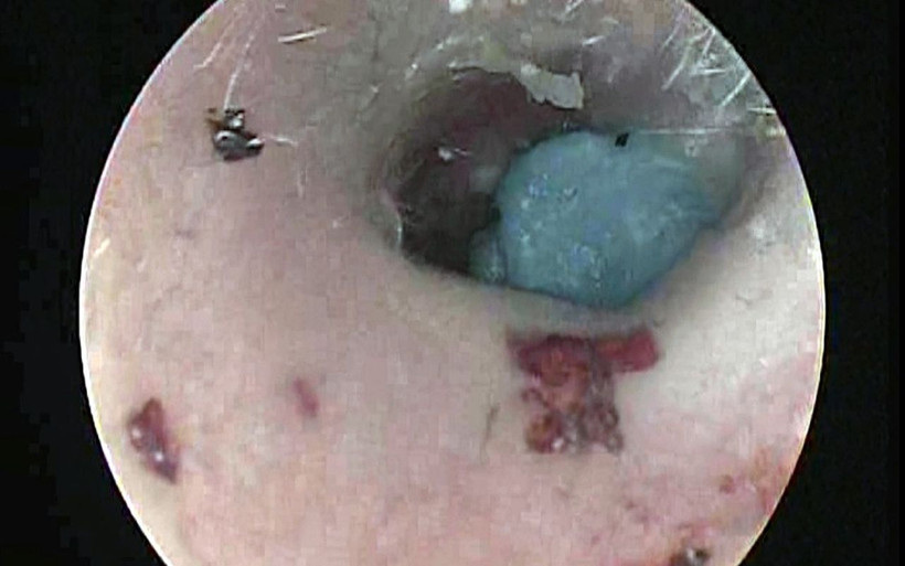 Kulaktan çıkanlara kimse inanamadı! Düzce'de doktor 17 yılda biriktirdi: Gerçekten büyüktü - Resim: 3