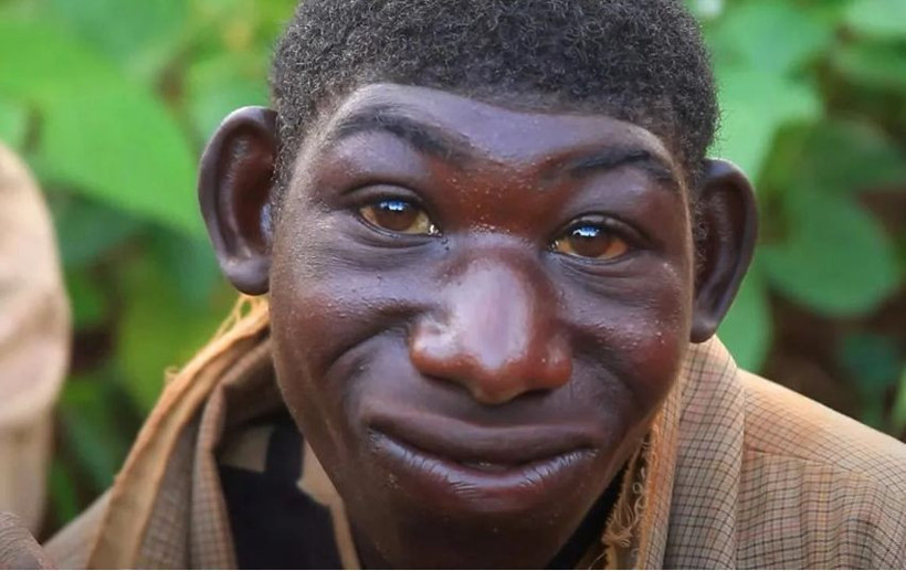 Görünüşü sebebiyle dışlanıp ormanda yaşayan genç köyüne döndü - Resim: 2