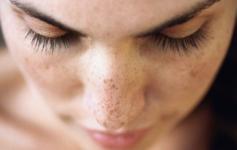 Vücuttaki güneş lekelerinden kurtulmanız için 12 mucizevi yöntem! - Resim: 2