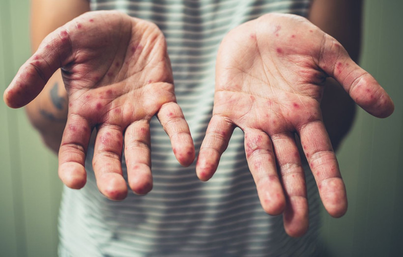 İstanbul'da yeni salgın patladı! Kızamık nedeniyle çocuklar ölmeye başladı! 'Aşı yaptırın' uyarısı geldi - Resim: 4