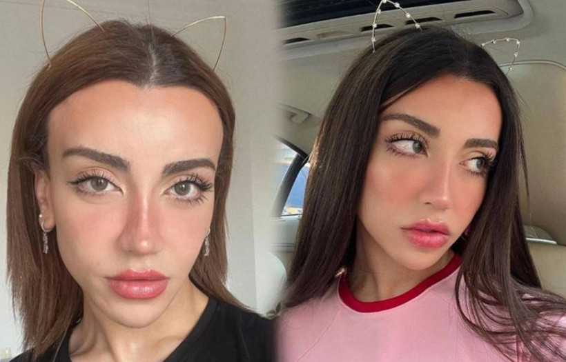 Mika Raun'un son hali görenleri şok etti! Estetik mağduru... - Resim: 1