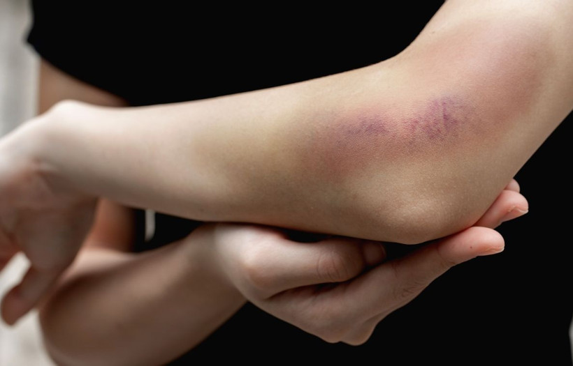 Vücudumuzdaki morluklardan doğal yollarla kurtulabilirsiniz - Resim: 1