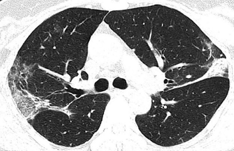 Koronavirüsünün akciğerlere verdiği zarar böyle görüntülendi - Resim: 2