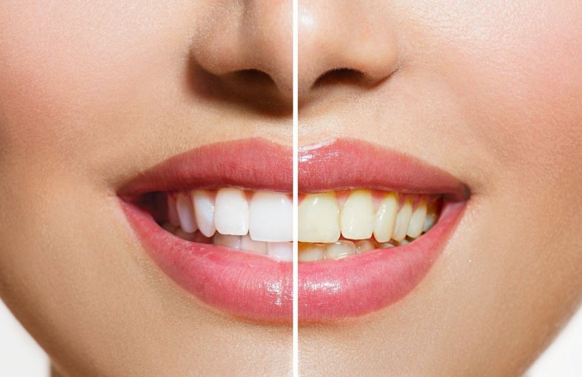 Sararan dişler nasıl beyazlatılır? Evde bu yöntemlerle dişlerinizi ışıl ışıl yapabilirsiniz - Resim: 2