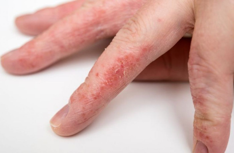 Uzmanı uyardı! Mevsim geçişlerinde alerjik egzamaya dikkat...Nelere dikkat edilmeli - Resim: 2