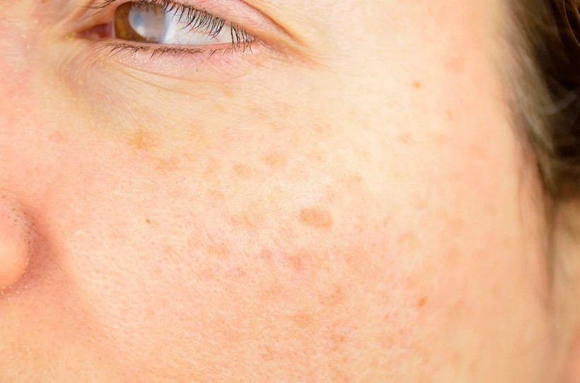 Vücuttaki güneş lekelerinden kurtulmanız için 12 mucizevi yöntem! - Resim: 1