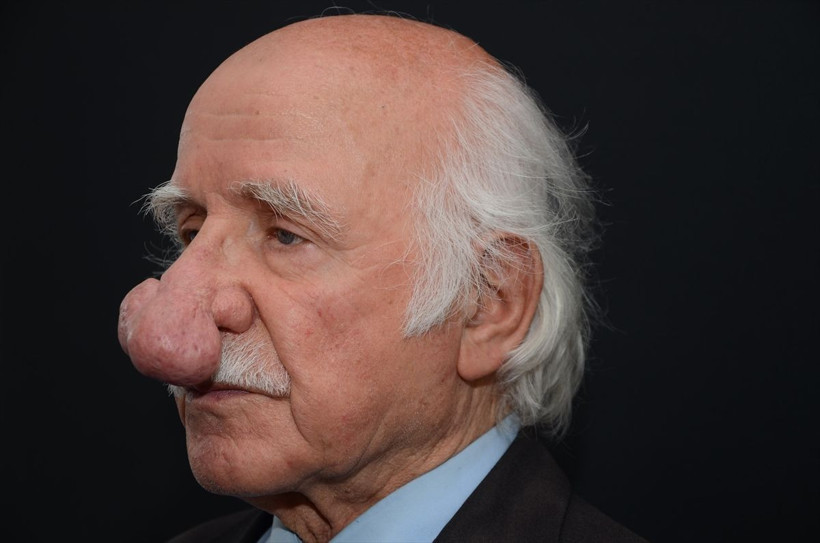 84 yaşındaki hastanın burnundan 100 gramlık kitle alındı! Son hali şaşkına çevirdi - Resim: 1