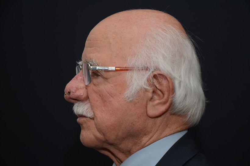 84 yaşındaki hastanın burnundan 100 gramlık kitle alındı! Son hali şaşkına çevirdi - Resim: 4