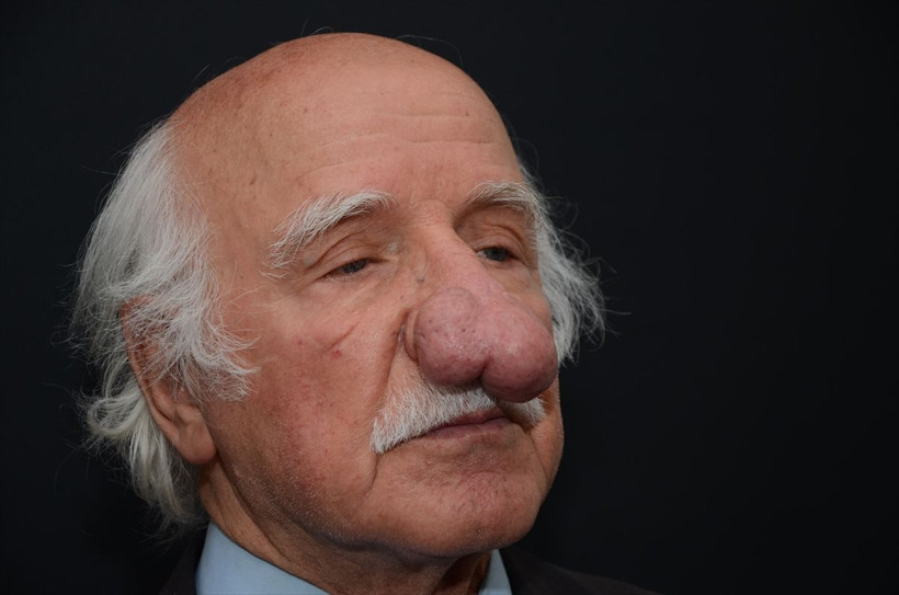 84 yaşındaki hastanın burnundan 100 gramlık kitle alındı! Son hali şaşkına çevirdi - Resim: 2