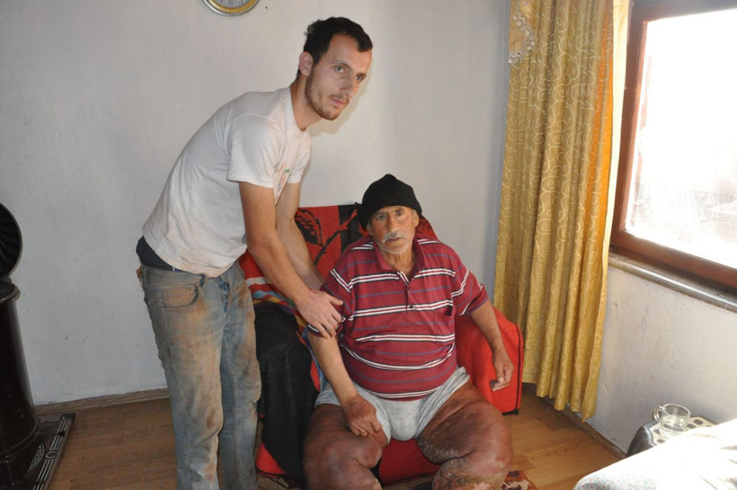 Çürüyen bacaklarını kurtlar yiyor ağır koku yüzünden eve kimse giremiyor - Resim: 2