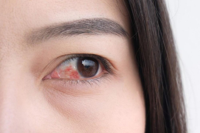 Uzman Opr. Dr. Tuncay Sezgin uyardı! Koronavirüste çarpıcı ''kırmızı göz'' belirtisi! - Resim: 3