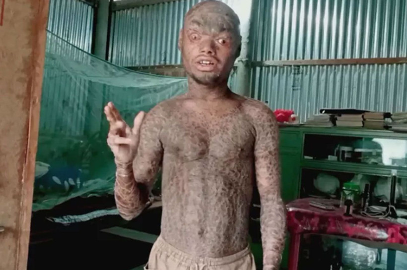 Hastalığına inanamayacaksınız! Her hafta deri değiştiriyor, çocuklar ondan kaçıyor - Resim: 1