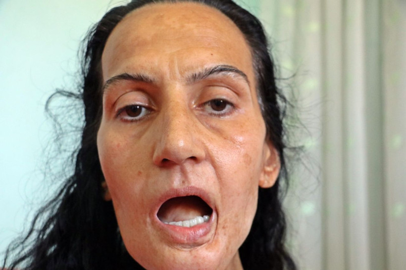 Dil kanserine yakalandı, bacağından parça alıp yeni dil yapıldı - Resim: 1