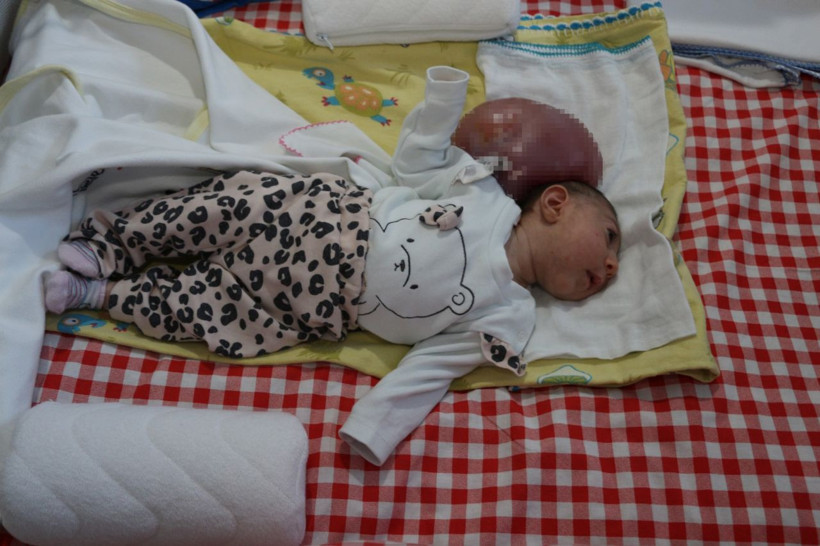 İki kafalı doğdu! Doktorlar yaşamaz dedi - Resim: 2
