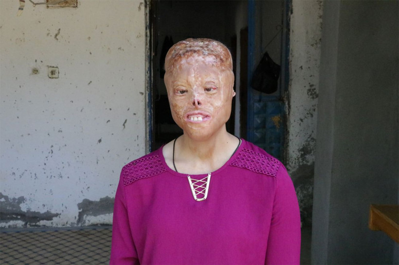 Başörtüsü yanınca bu hale geldi! Çocuklar korkuyor diye okula almıyorlar - Resim: 1