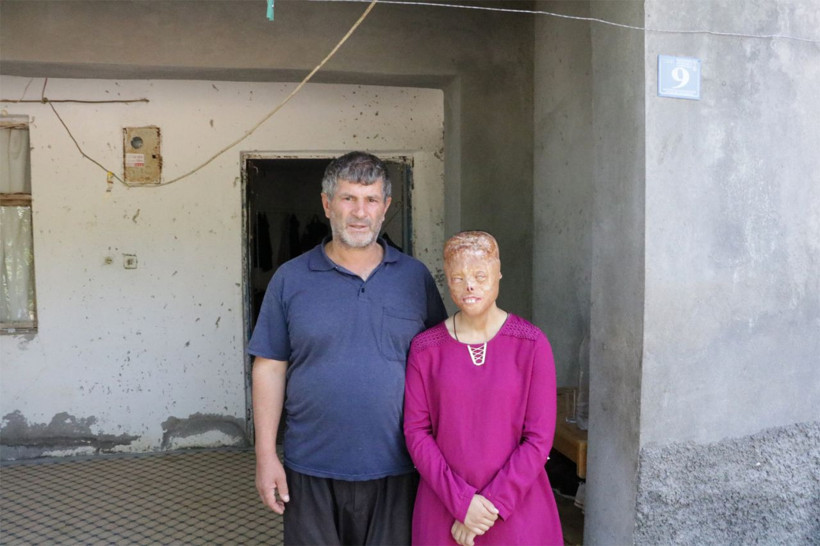 Başörtüsü yanınca bu hale geldi! Çocuklar korkuyor diye okula almıyorlar - Resim: 2