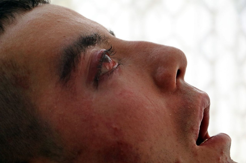 5 yıldır gözlerini kırpamıyor her şey üniversite 2. sınıfta başladı - Resim: 2