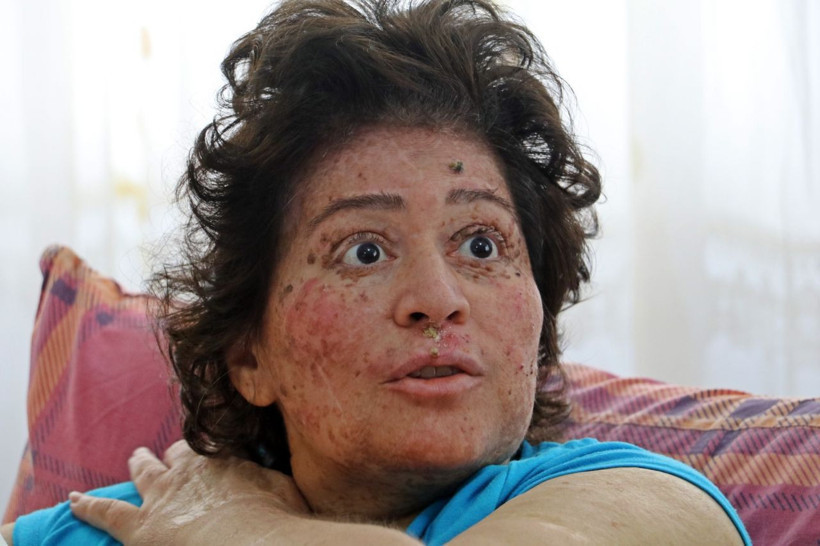 Korona değil güneş eve hapsetti her gün parça parça organları kesiliyor - Resim: 2