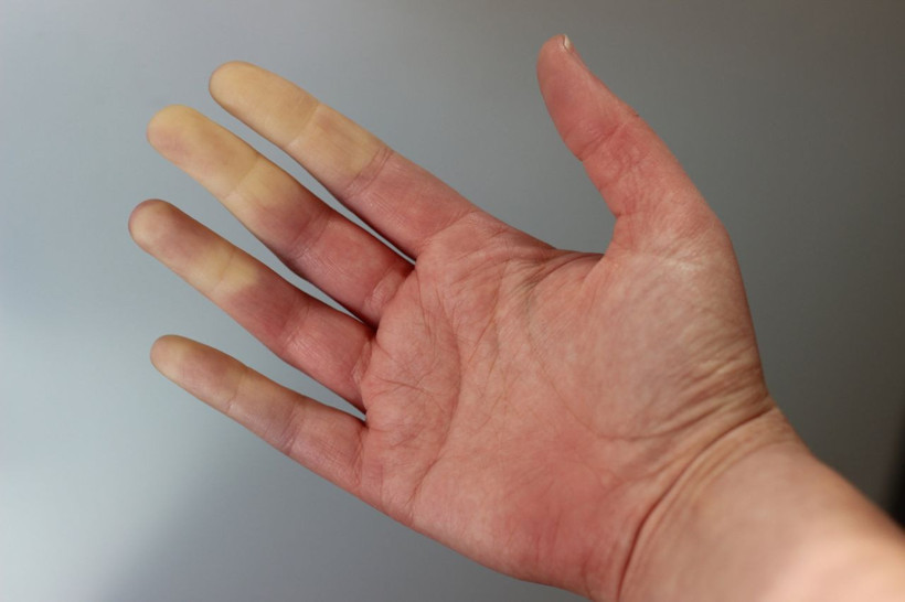 Raynaud fenomeni nedir meslek hastalığı mı damarları etkiliyor! - Resim: 3