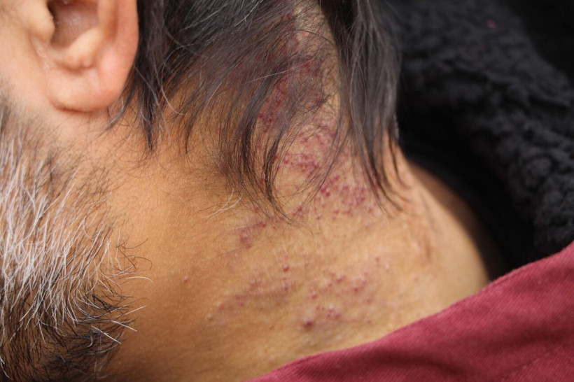 Batman'da 12 yıldır teşhis konulamadı! Kafasında çıktı hayatı karardı: Öldürmüyor süründürüyor - Resim: 2