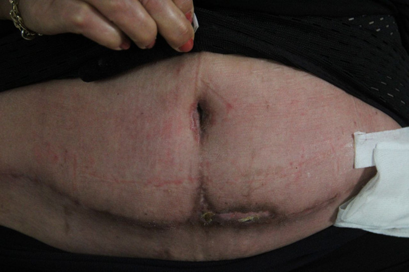 Bankadan kredi çekip güzelleşmeye gitti vücudu haritaya döndü! Kasap gibi kesip biçti - Resim: 4