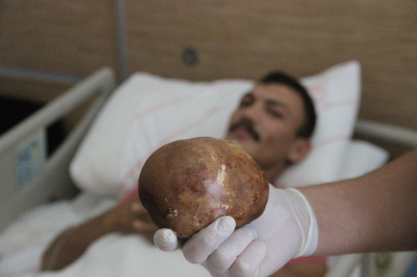 Türkiye'de böylesi görülmedi patatese benziyor Karamanlı gencin mesanesinden çıktı - Resim: 4