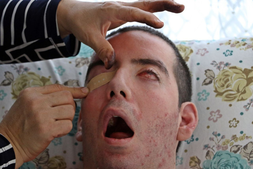 Görme bozukluğuyla başladı! 10 yıldır gözlerini kapatamıyor - Resim: 1