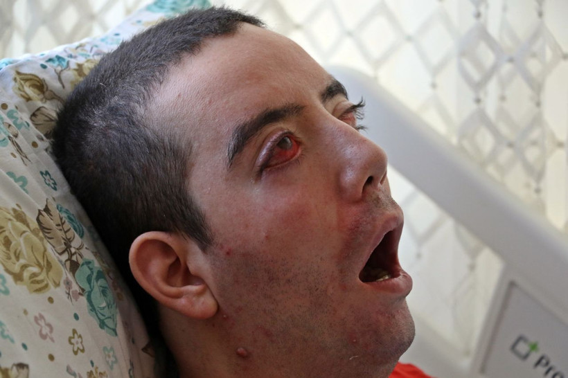 Görme bozukluğuyla başladı! 10 yıldır gözlerini kapatamıyor - Resim: 3