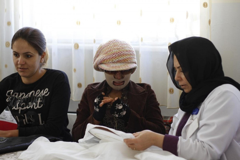 Yüzü yanan kadın ailesinin desteğiyle hayata tutundu - Resim: 2