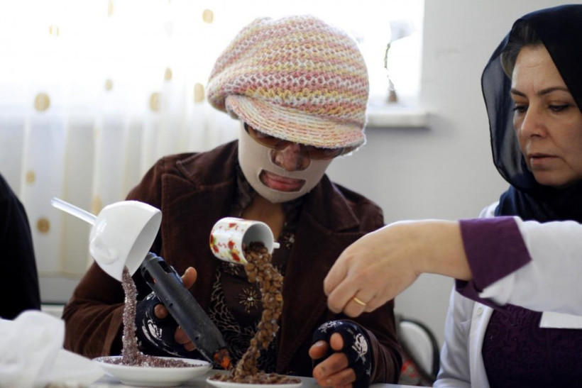 Yüzü yanan kadın ailesinin desteğiyle hayata tutundu - Resim: 3