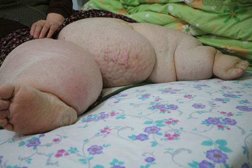 Fil hastalığı nedeniyle 4 yıldır evden çıkamıyor - Resim: 1