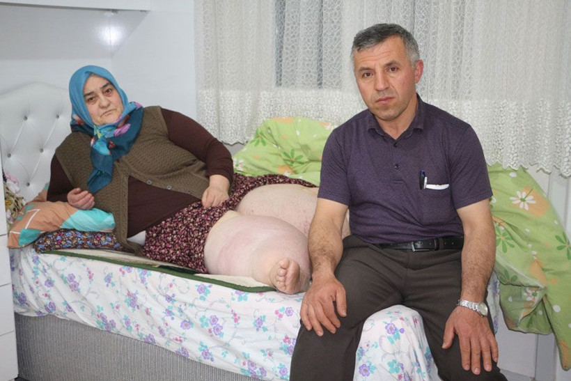 Fil hastalığı nedeniyle 4 yıldır evden çıkamıyor - Resim: 2