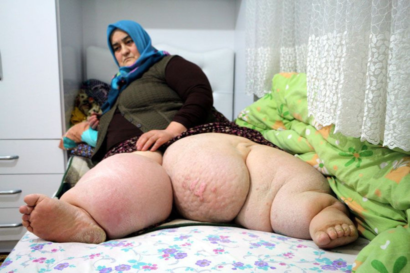 Fil hastalığı nedeniyle 4 yıldır evden çıkamıyor - Resim: 3