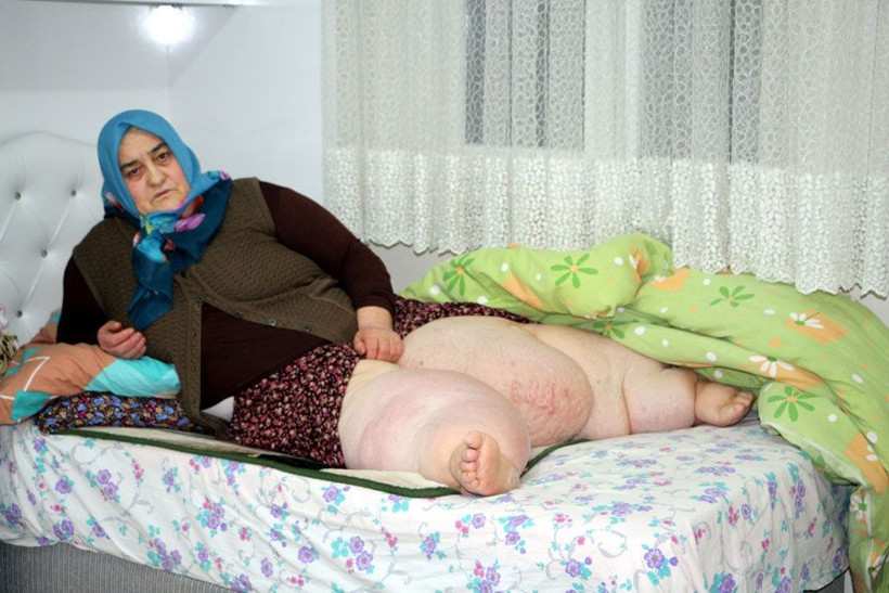 Fil hastalığı nedeniyle 4 yıldır evden çıkamıyor - Resim: 4